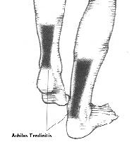 Achilles Tendinitis Institute for Physical and Sports Therapy